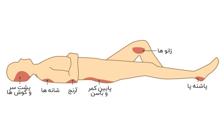 درمان زخم بستر با عسل طبیعی | کامی عسل